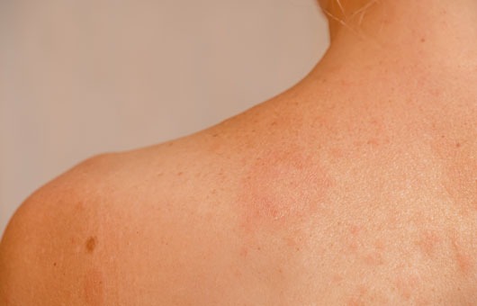Pityriasis Versicolor